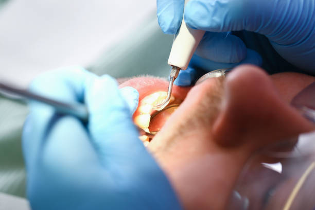 Best Emergency Tooth Extraction in Rice, TX